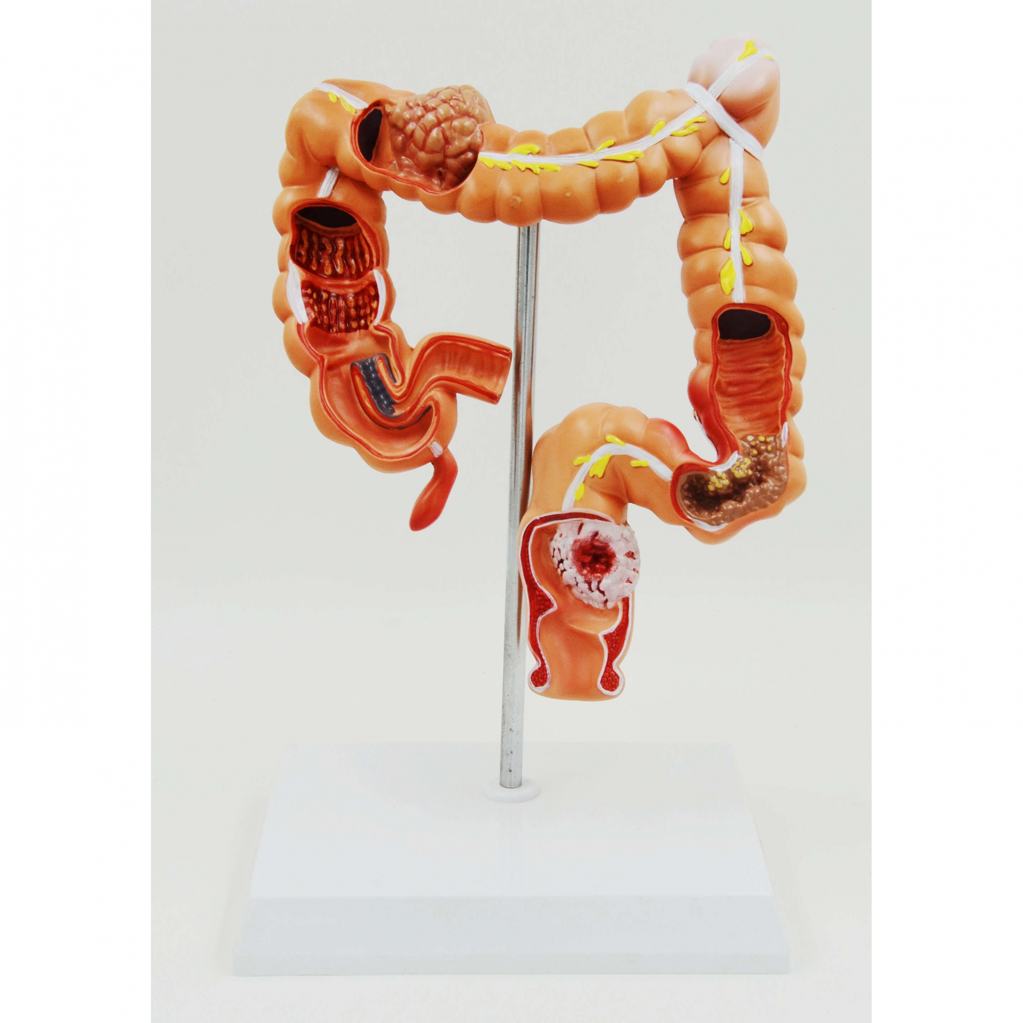 A1730 Патологическая модель толстой и прямой кишки