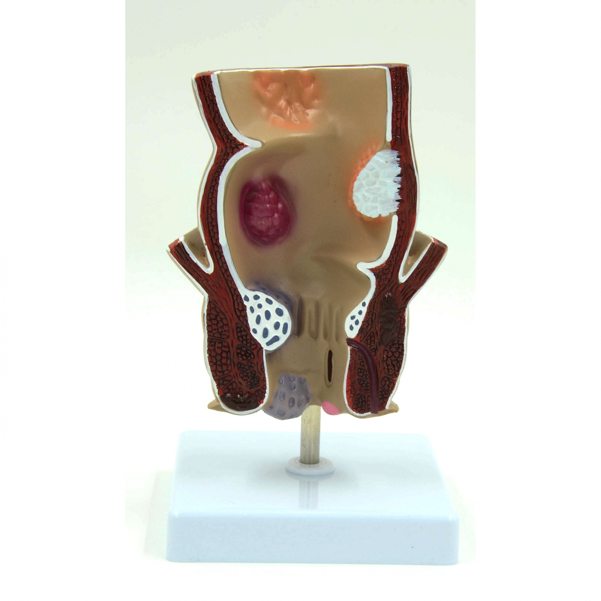 A457 Модель патологий прямой кишки  и заднего прохода