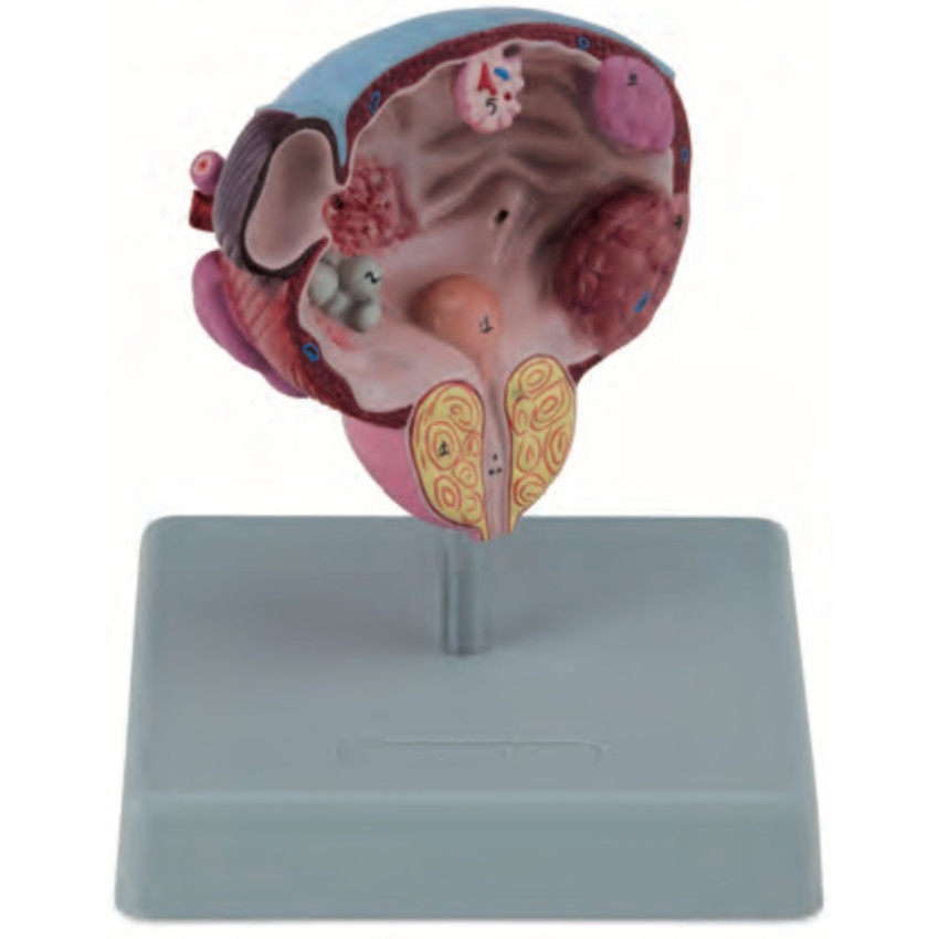 A738 Модель почки с камнем