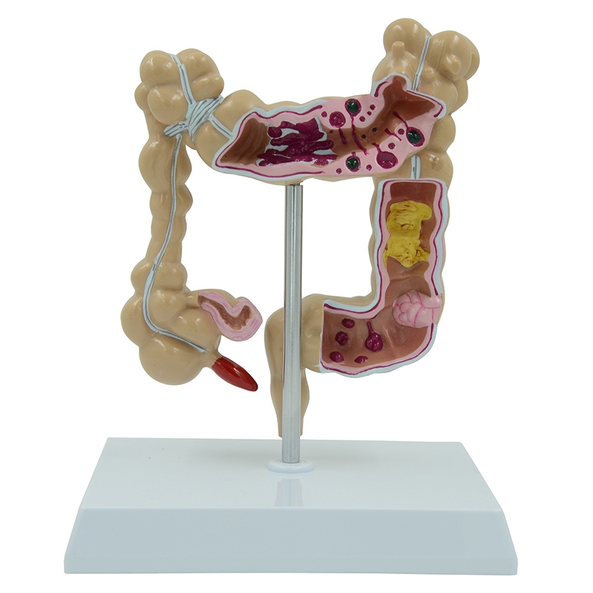 A745 Модель патологий толстой кишки